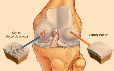 Tot ce trebuie să știi despre artroză: simptome, cauze, tratament