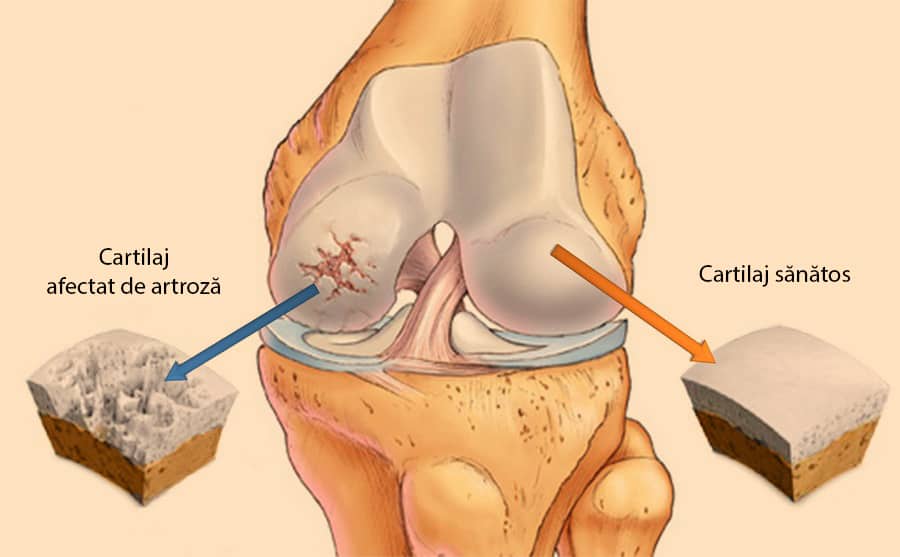 Boala articulară și modul de tratament Osteoartrita: Simptome, Cauze, Tratament